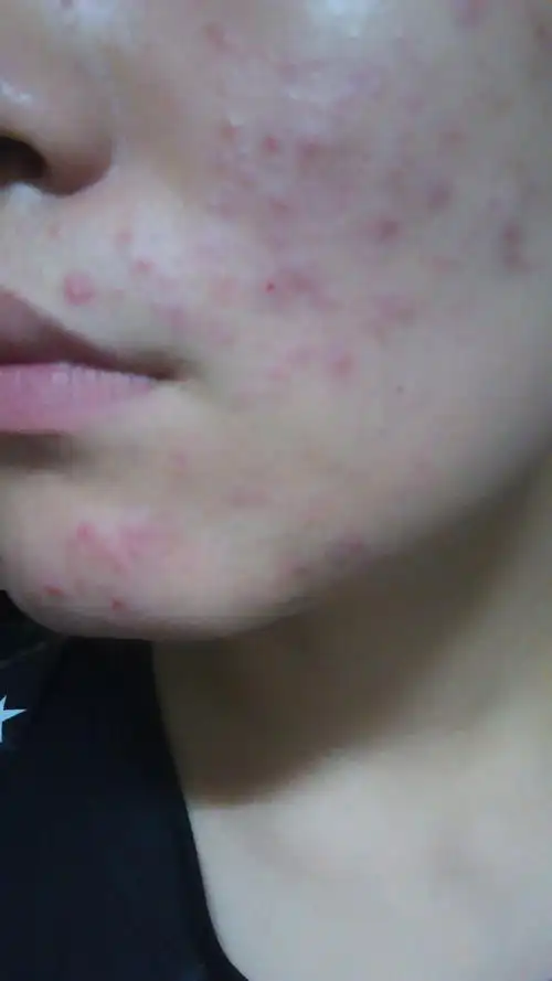 求大神告诉我为什么最近跑完步以后脸上就长这样的痘!是过敏还是别的?