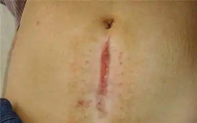 15位妈妈的剖腹产疤痕照片,看完太心酸,母亲伟大