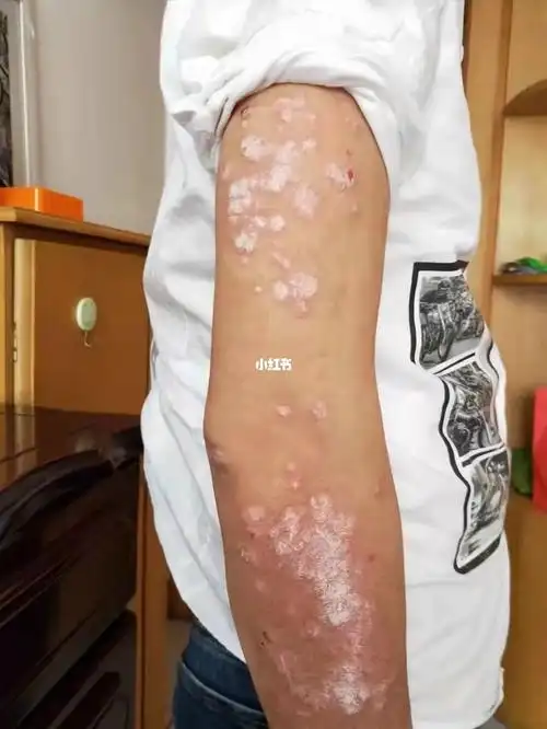 基因疗法治愈牛皮癣!