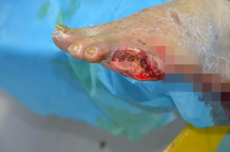 糖尿病足严重程度不同症状也不同,糖尿病足是如何分级的?_坏疽