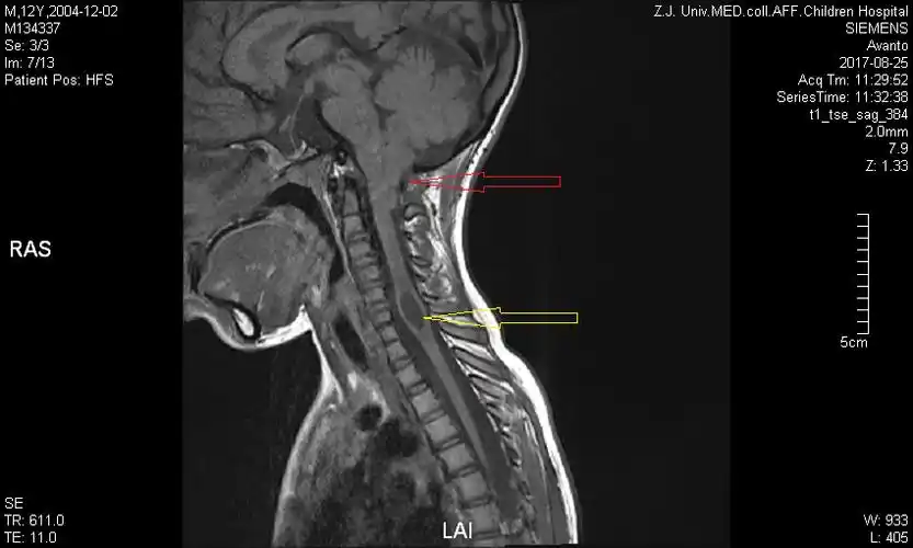 小脑扁桃体下疝的治疗