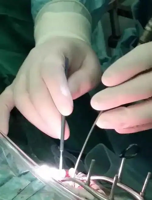 指尖巧弄琅玕影显微神经外科剥离子