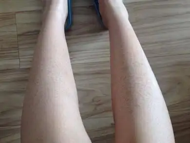 怎样去除小腿天生蛇皮