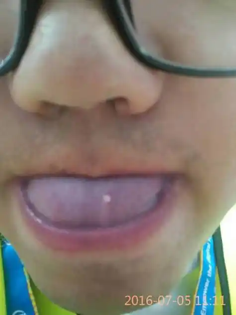 舌头上长了个白色的小疙瘩,已经有一个月了,不疼不痒,这是怎么回事