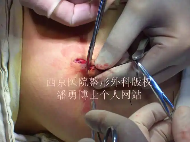 乳头内陷矫正手术全过程 - 好大夫在线
