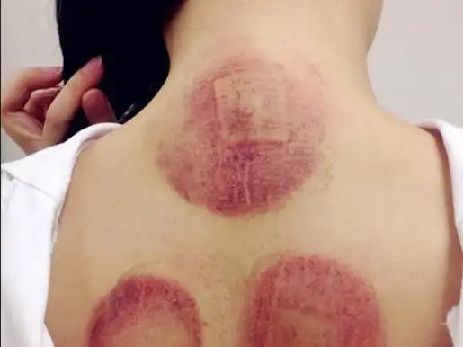 会处于真空状态,使罐子牢牢的吸附在皮肤上,当背部受到强烈的挤压后