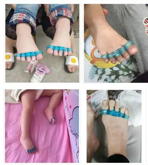 颖健婴儿童脚趾头小孩大拇指外翻器宝宝重叠分离器分趾大母指内扣日夜