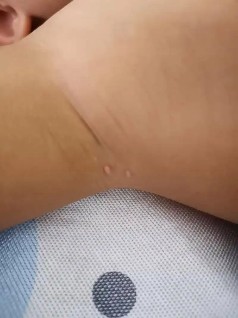 求助,宝宝传染性软疣能自愈吗 请问大家一岁多宝宝长了传染性软疣能