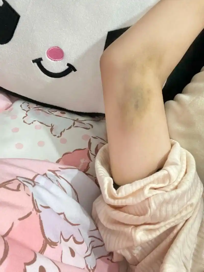 也不知道怎么伤的 我是真滴牛,每次撞的青一块紫一块我都不知道,这么