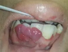 牙龈瘤