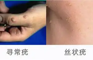 hpv有什么表现症状女性照片图真实女性早期hpv感染图片