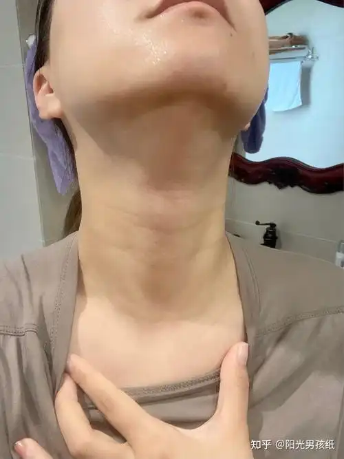 肤色再白再嫩,但是脖子上有一条条的"项链"也是直接从100分降到10分!