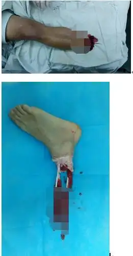 益阳男子脚被绞断 奇!看岳阳医师如何接活?胆小慎点
