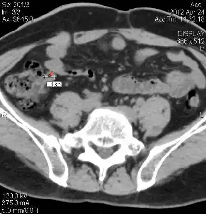 10幅图教你学会在ct片上找到阑尾!_手机搜狐网