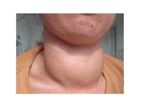 甲亢脖子症状图片 (51)