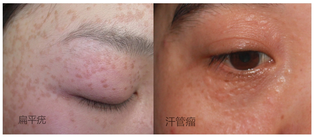 扁平疣vs汗管瘤.png