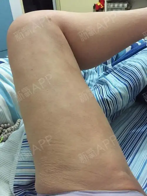 大腿丫皮皱巴巴的,估计是抽多了的原因.满月啦,可以不忌嘴咯