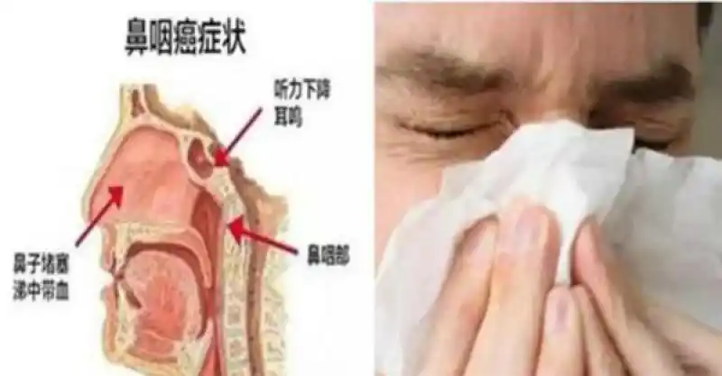 15岁男孩已是「鼻咽癌晚期」,尤其是喜欢吃「这个」的你要注意了!