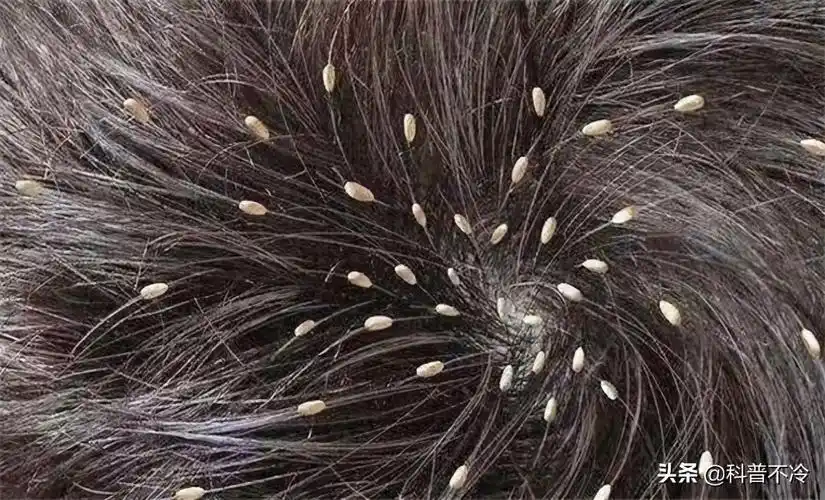 几乎人人身上都有虱子全身都有虱子