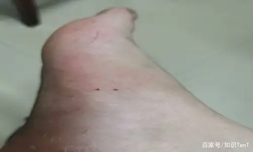 被银环蛇咬伤的伤口