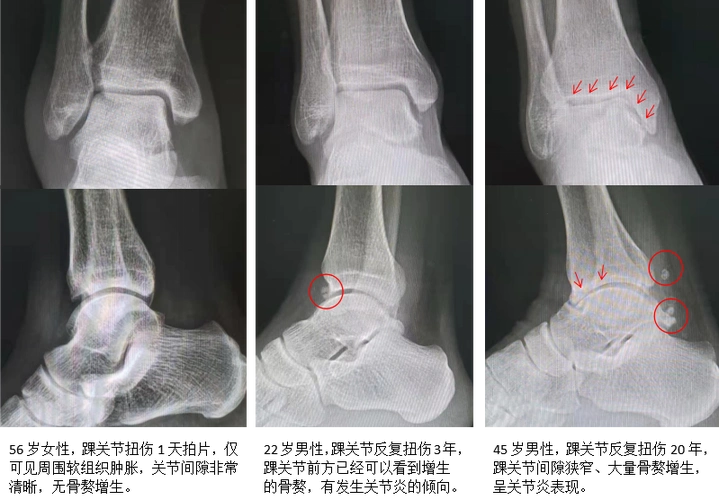 慢性崴脚在悄悄的破坏你的踝关节_踝部扭伤_介绍_治疗方式_日常注意