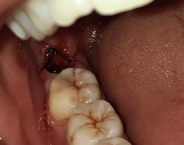 拔牙相关18大护理禁忌雷区总结,时刻小心_口腔_牙齿_问题