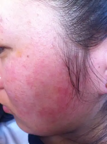 脸发热是怎么回事原因都在这里