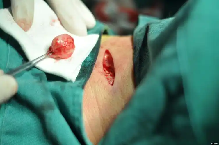 【讨论】今天做的 皮脂腺囊肿 [病例帖]