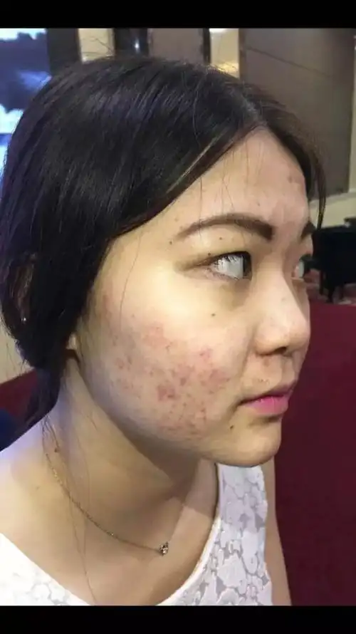 "爆痘妹"的完美祛痘史,祛痘快速见效!