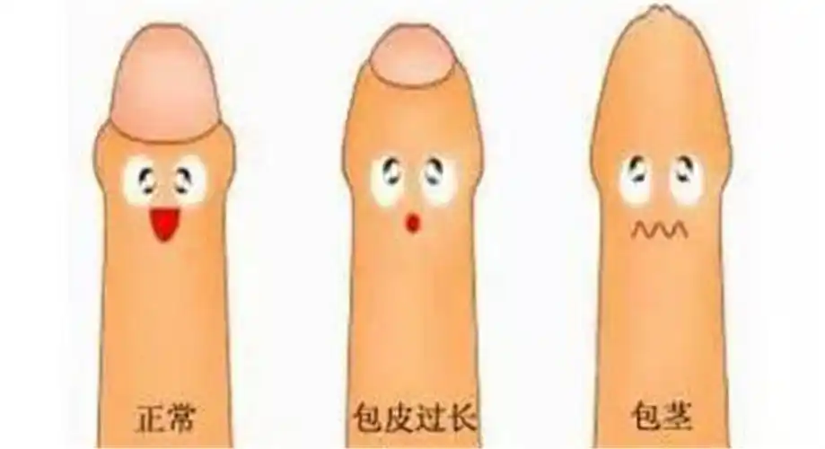 岁少年包茎手术前照片_有来医生