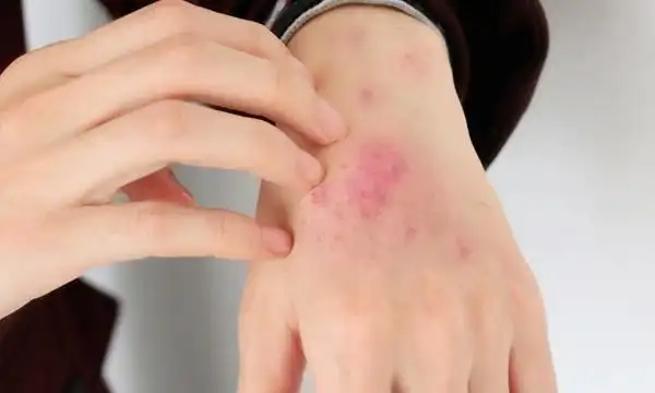 艾滋病的初期皮疹特点_艾滋病初期_艾滋病感染初期症状