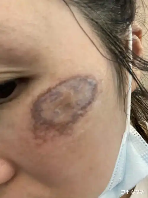 脸部擦伤恢复记录,希望我足够好运不会留疤.