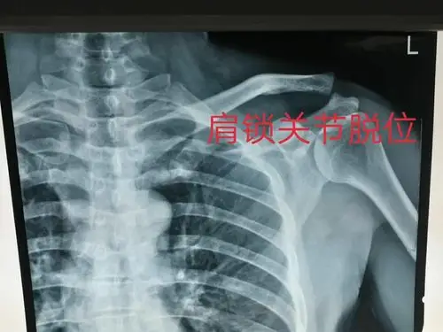 肩锁关节脱位