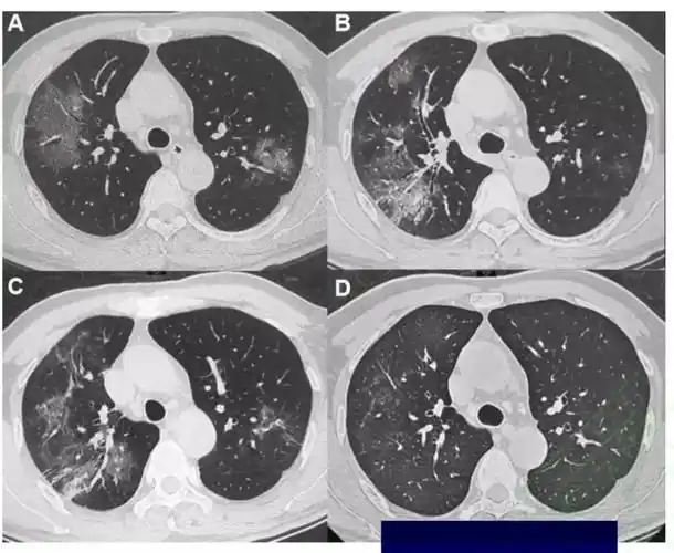 新型冠状病毒感染的肺炎ct影像学表现