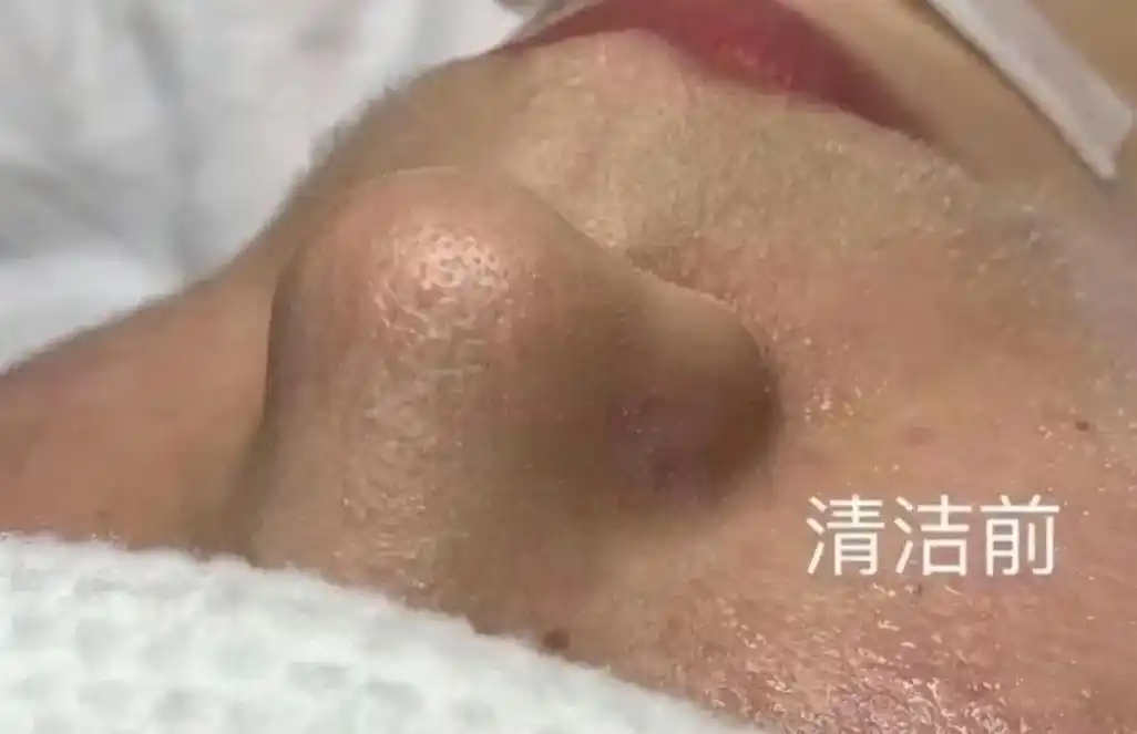 小气泡深层清洁补水.