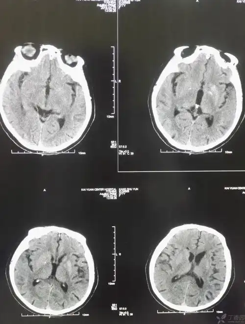 女,77岁,右侧肢体不灵一天,做头ct,左侧基底节区密度偏高,ct值41hu