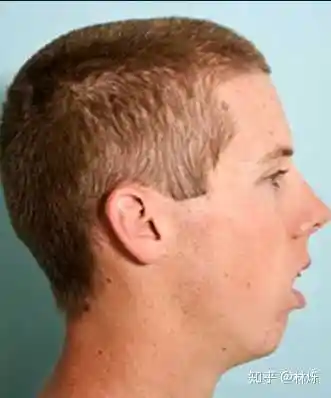 张嘴呼吸面容变丑能恢复吗?