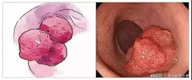 大便时,除了便血,还有这两个症状,你可能是被肠息肉盯上了