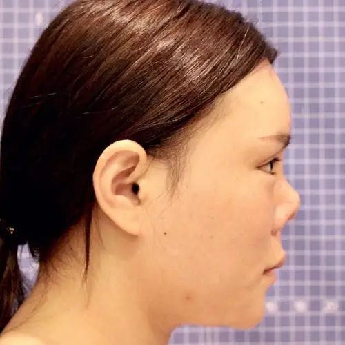 挛缩鼻,之前植入的硅胶假体包膜增厚,所以就会牵拉鼻尖形成"猪鼻子"