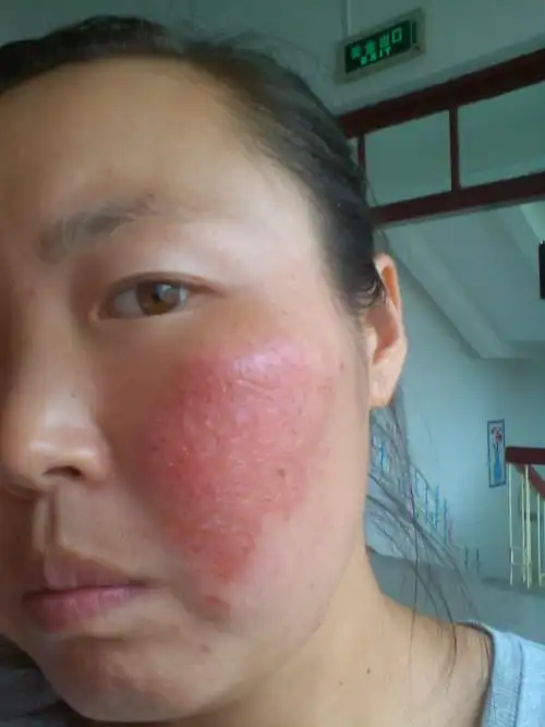 医生您好,我是一名在校大学生,皮肤紫外线过敏,现在已经到了特