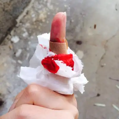 各位宝妈们,现在怀孕2个月,今天我不小心手指被刮眉刀画伤了,流了很多