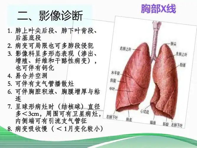 2013版肺结核诊治指南ppt