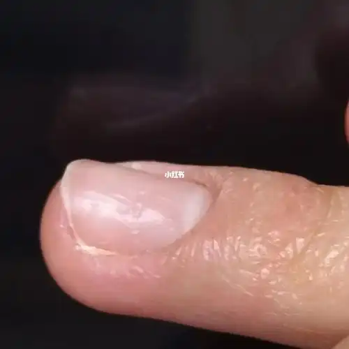 指甲多了一个小坑#记录生活