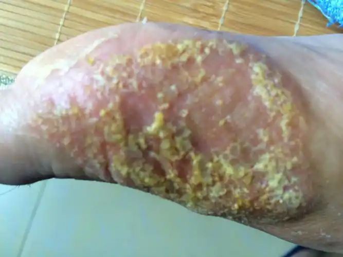 脚藓两个多月了,第一次,以前没有,有抹药膏,每次