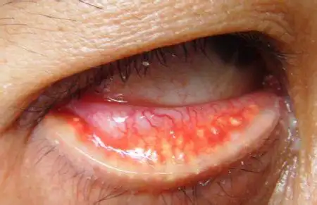 眼脸挤出很多膏体一样的东西,这是怎么回事?