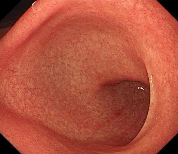 真实胃镜揭秘全过程