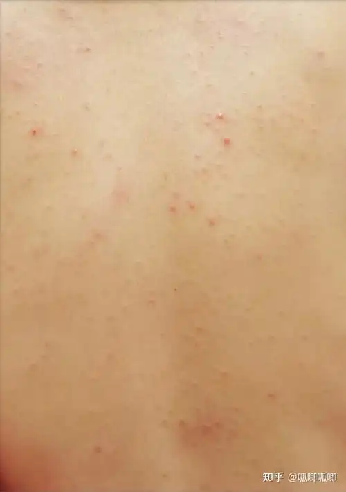 你的螨虫背是怎么好的