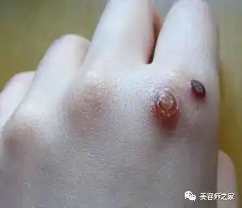 瘊子一般指的是寻常疣,是质地比较坚硬的突起, 有些外观上有颗粒样