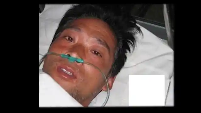 近距离遭受核辐射,强行续命存活83天,他的愿望:早点解脱