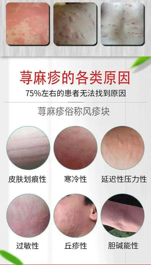 风疹和荨麻疹的区别「百度扫一扫识别皮肤病」